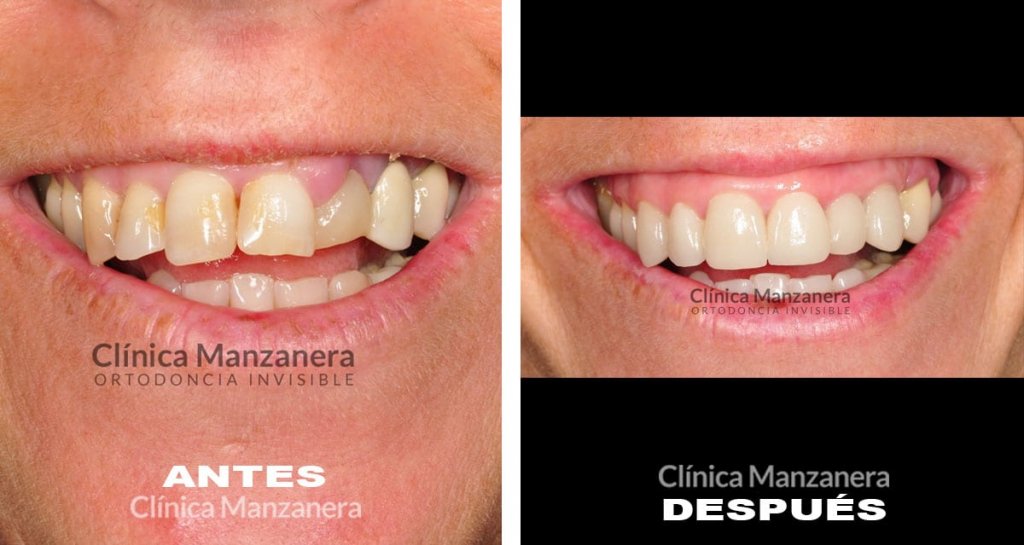 Fundas Dentales: Todos los Tipos de Fundas Dentales y Precio!