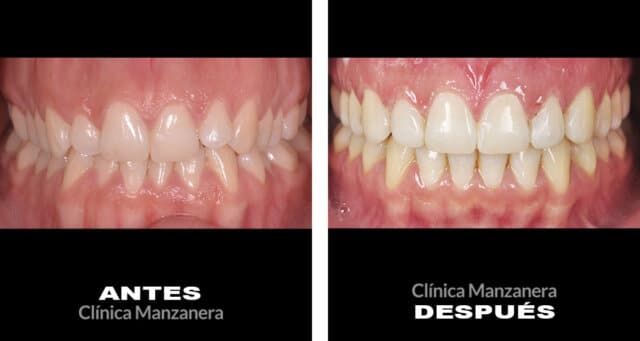 antes y después ortodoncia y tratamiento estético