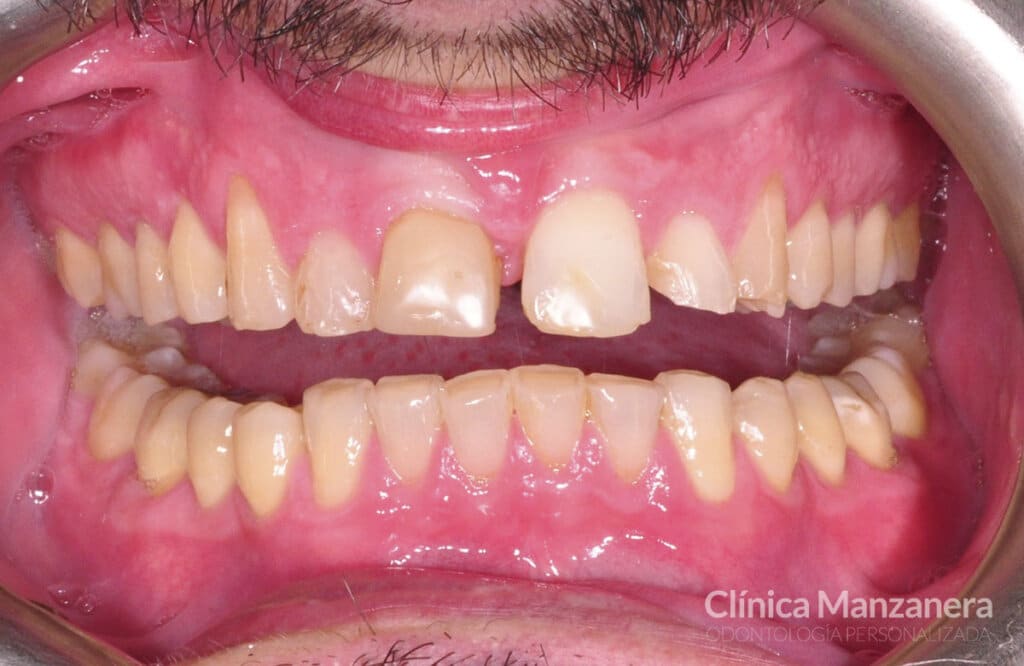 caso resuelto diastema antes